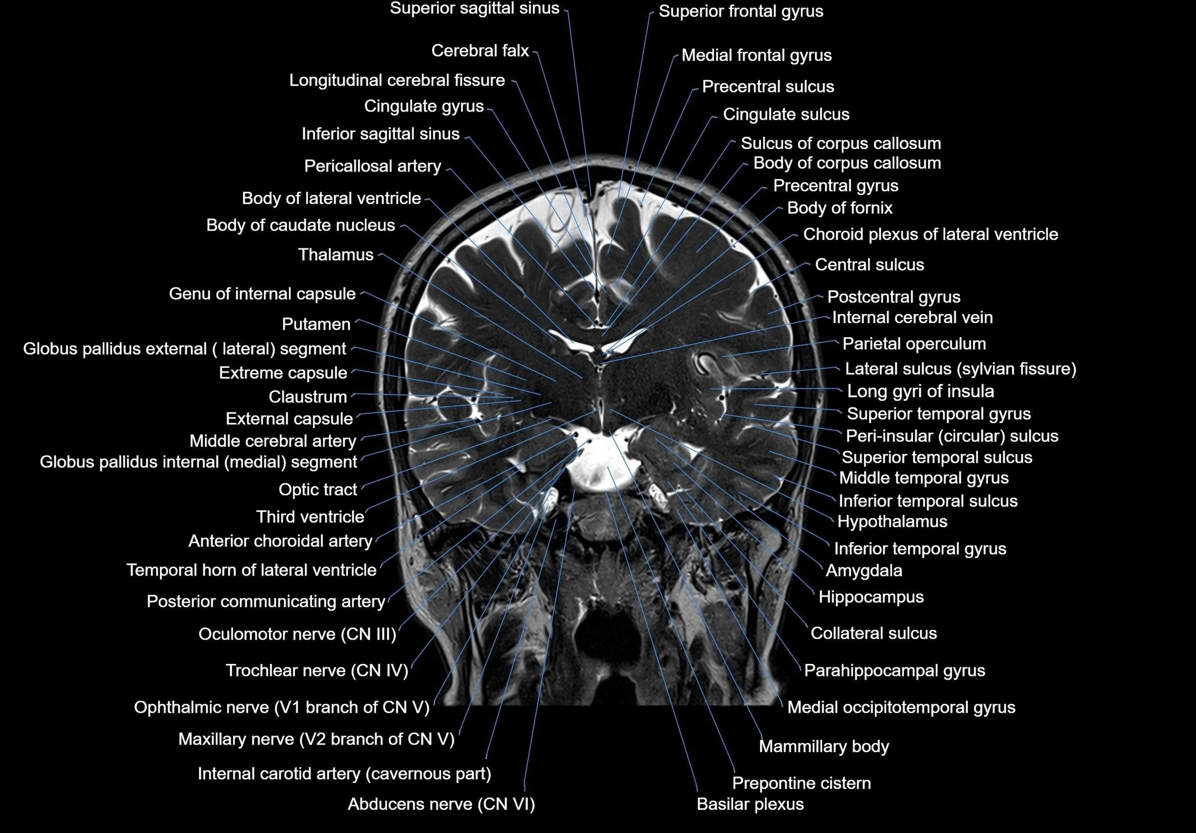 MRI Brain coronal cross sectional labelled anatomy 3T image  -img-00001-00036.webp
